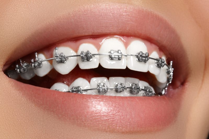 Precio Blanqueamiento Dental Adeslas 8